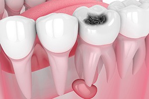Illustration of decayed tooth, which may need to be extracted