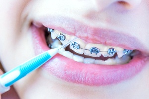 Close-up of interdental brush being used beneath braces wire