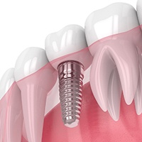 Single dental implant successfully integrated with surrounding bone