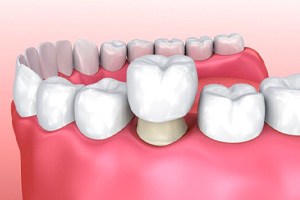 Illustration of crown being placed on tooth