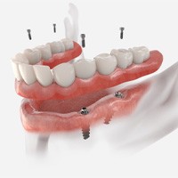Illustration of implant denture being secured in lower jaw