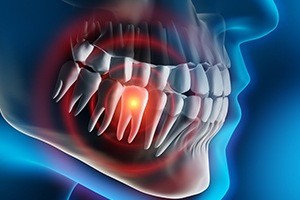 Animated smile highlighting damaged tooth in need of extraction