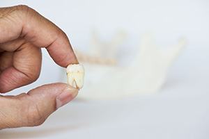 Close-up of hand holding tooth after extraction procedure