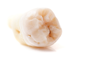 Extracted tooth isolated against white background