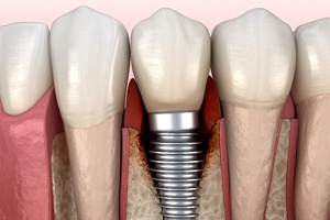 Illustration of peri-implantitis, a common cause of dental implant failure