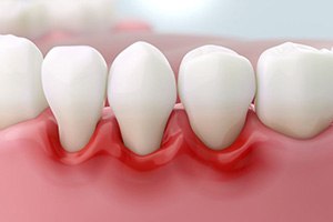 Illustration of receding gums around teeth