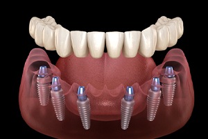Illustration of implant dentures for lower arch against dark background