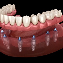 Illustration of implant dentures for lower arch against dark background