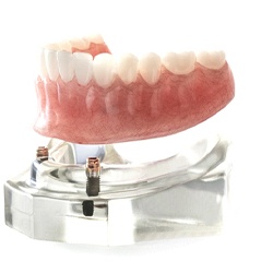Removable implant denture on top of dental model