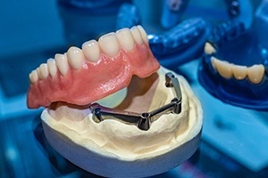 Model dental implant retained denture