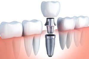 Animated dental implant supported dental crown placement