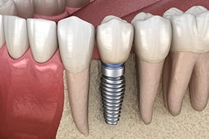 Animated smile with dental implant supported replacement tooth