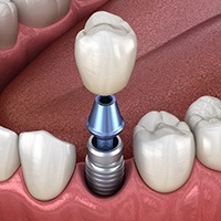 Animated dental implant supported dental crown placement