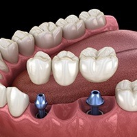 Animated dental implant supported fixed bridge placement