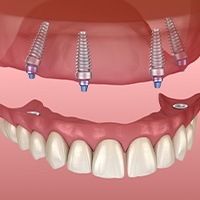 Animated dental implant supported denture placement