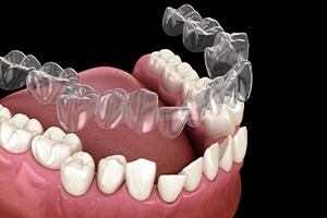 Animated smile during Invisalign® clear braces tray placement