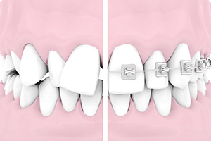 Animated smile before and during orthodontic treatment