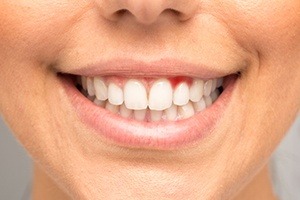 Closeup of smile with red gums caused by gingivitis