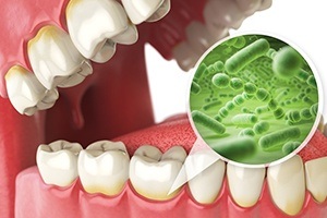 Animated smile with periodontitis represented by enlarged bacteria
