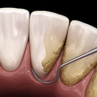 Illustration of dental scaler being used on teeth