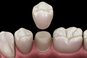 Animated smile during dental crown placement