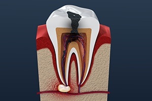 Animated tooth with decay and damage before root canal therapy