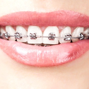 Close-up of woman’s smile with traditional braces in Bloomfield