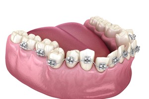 Illustration of traditional braces attached to crooked teeth