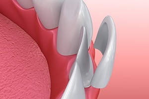 Animated smile during porcelain veneer placement