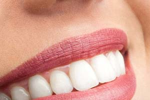 Close-up of woman’s beautiful smile with veneers in Bloomfield