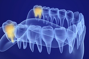 3 D rendering of smile with wisdom teeth highlighted