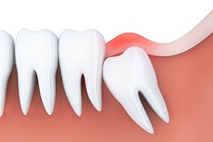 Animated smile with impacted wisdom tooth