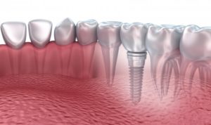 dental implant