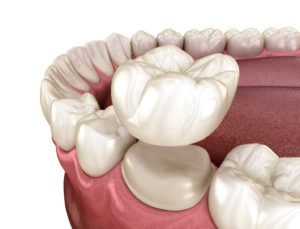 Illustration of dental crown in Bloomfield being placed on tooth