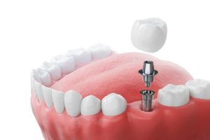 Illustration of dental implant being placed between natural teeth